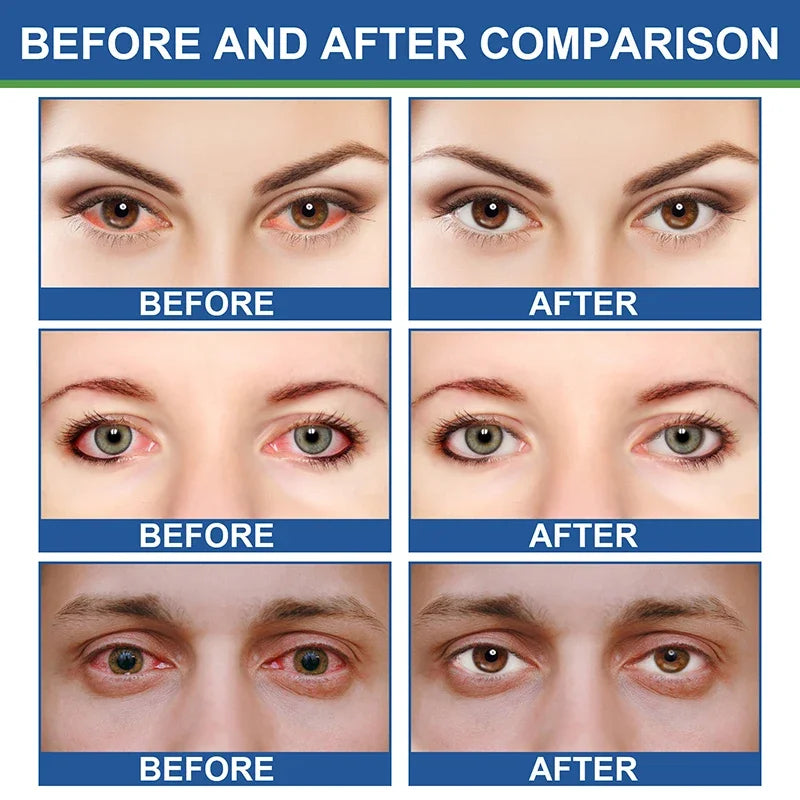 Rapid Treatment Eye Health Care Cream - Protects Eyesight, Relieves Myopia, Astigmatism, and Eye Fatigue